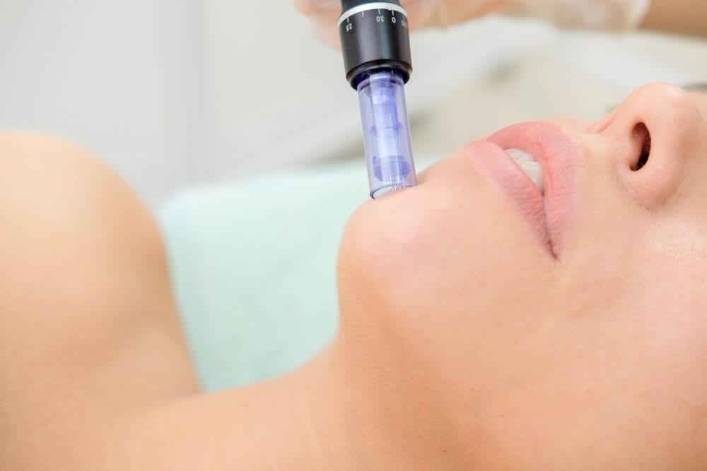 woman receiving microneedling treatment