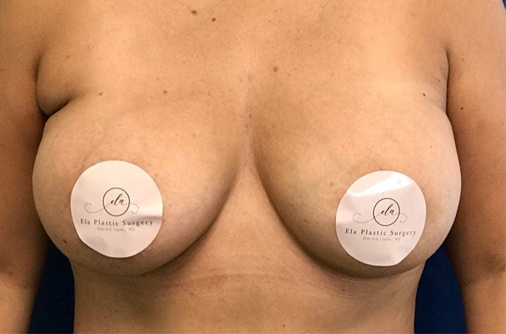 pair of breasts after breast augmentation
