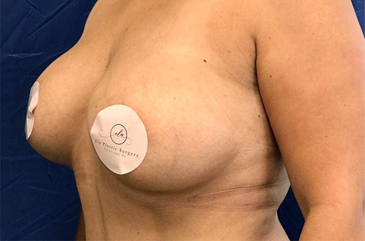 pair of breasts after breast augmentation