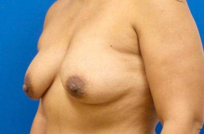 pair of breasts before breast augmentation
