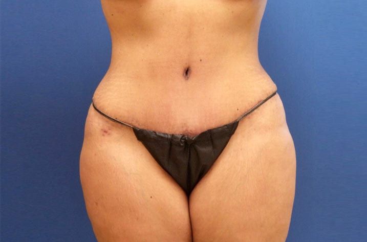 woman with stomach fat before tummy tuck procedure