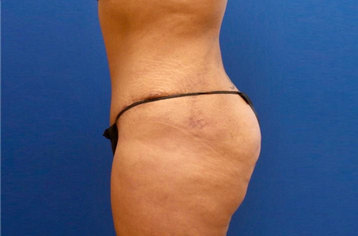woman with stomach fat before tummy tuck procedure