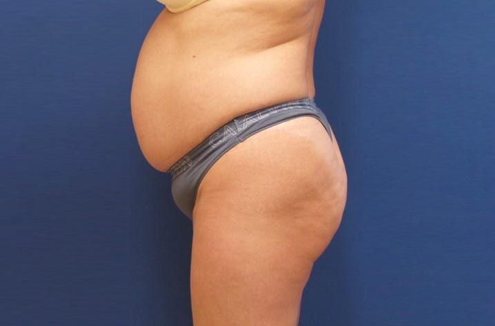 woman with bulging stomach