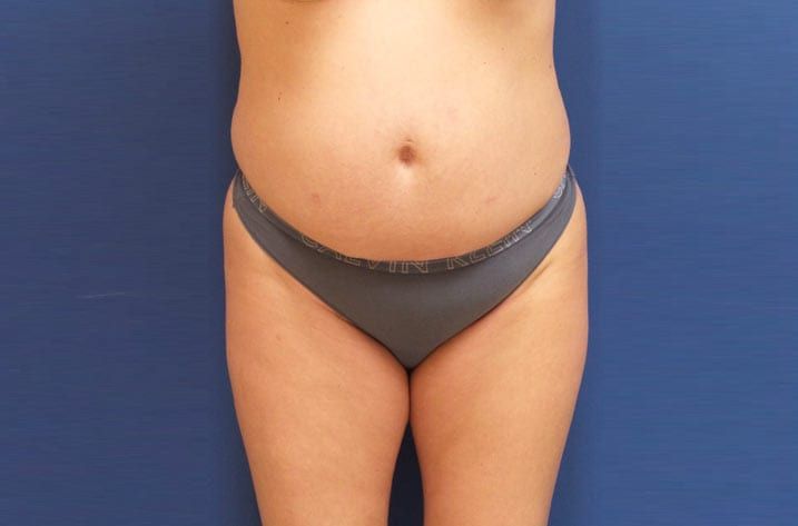 woman after tummy tuck